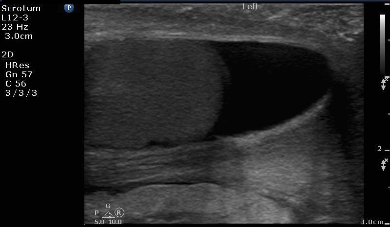 Figure 4_Hydrocele.jpg
