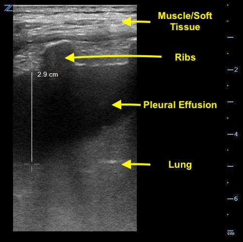 Thoracentesis Figure 3 - Measurement of depth to lung parenchyma.jpg