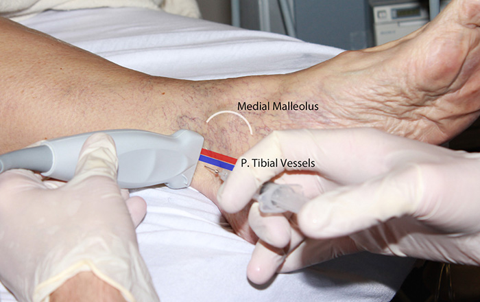 Figure 2. Tibial Hands out of plane position.jpg