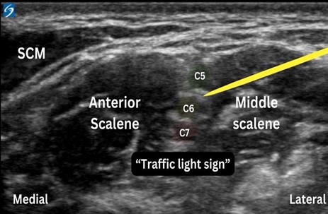 May2025-Pedi Interscalene_Fig 2.jpg