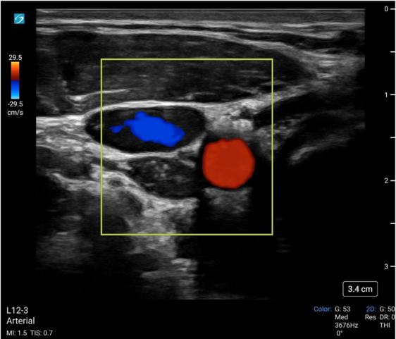 May2025Sonographic Fig 2 color pulse check.png
