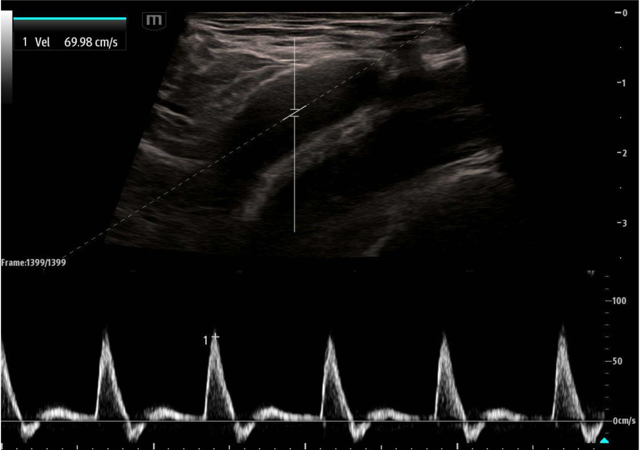 May2025Sonographic Fig 3 psv pulse check.png