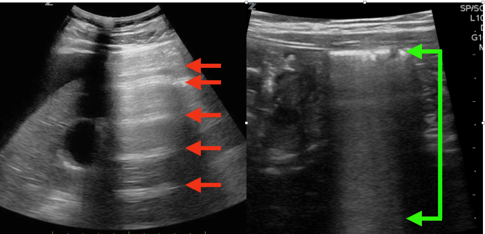 RUSH_Image 6 free air vs bowel gas.png