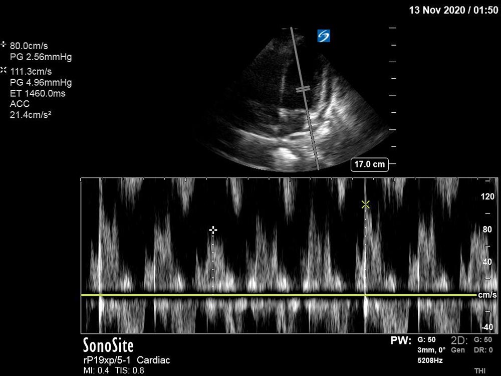 Doppler mitral inflow velocity.jpg