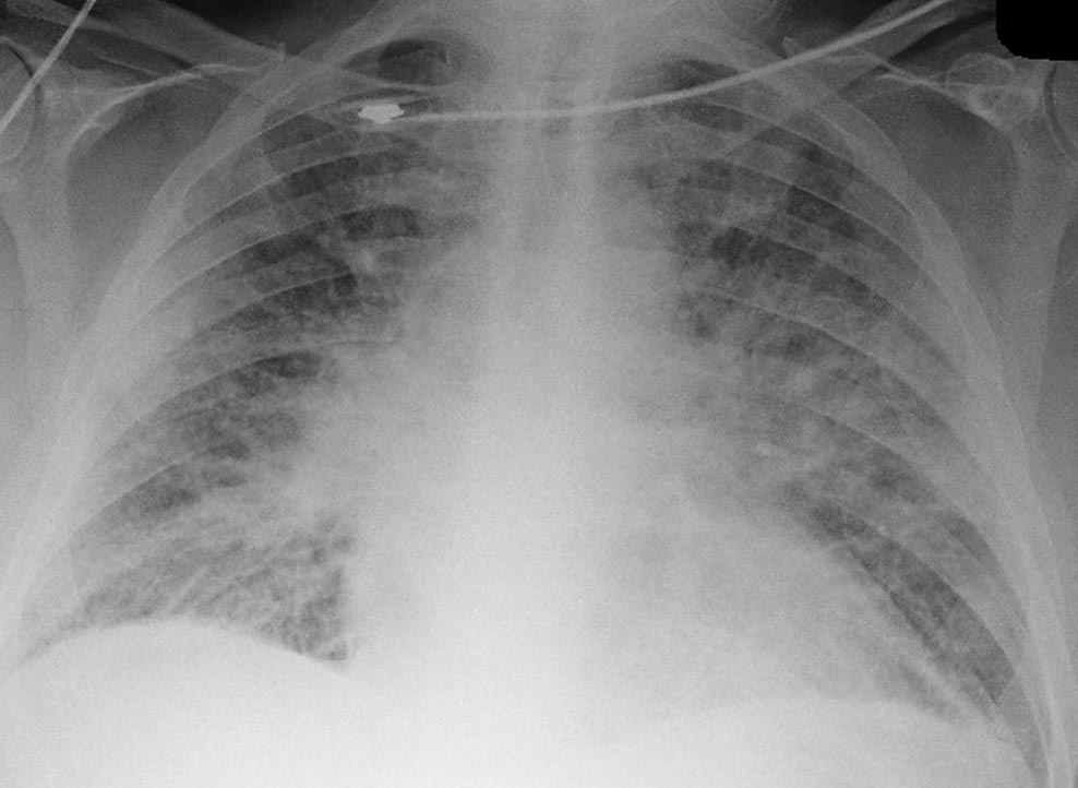 CXR-PulmCongestion.jpg