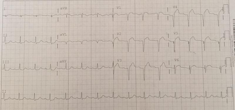EKG-ANT-MI.jpg