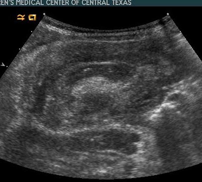 Intussuception Peds-4.jpg