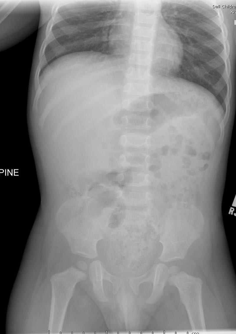 Intussuception Peds-6.jpg