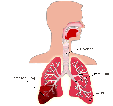 ICD-10 Pneumonia Vignette